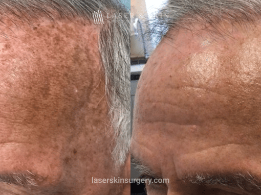 Fraxal and Q-Switched Ruby Laser for Sun Damage – LO Forehead