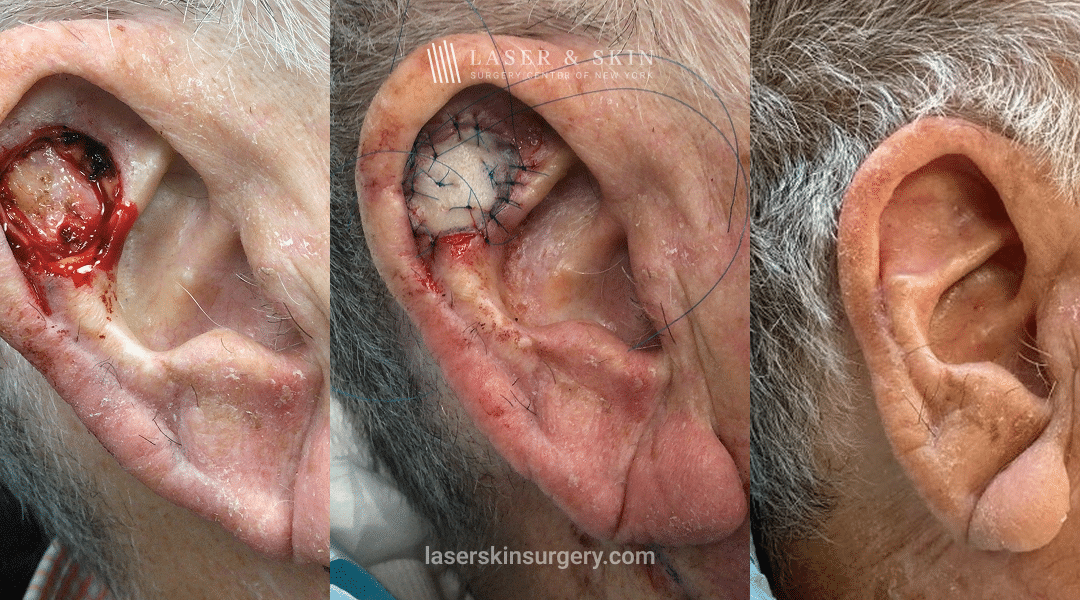 Mohs Skin Graft - 10 Month Change