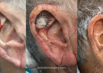 Mohs Skin Graft – 10 Month Change
