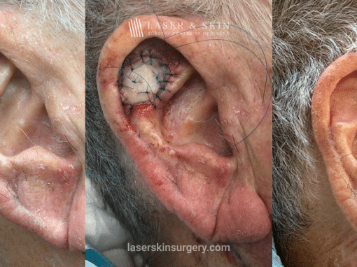 Mohs Skin Graft – 10 Month Change