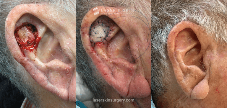 Mohs Skin Graft – 10 Month Change