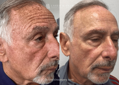 Fraxal and Q-Switched Ruby Laser for Sun Damage – RO