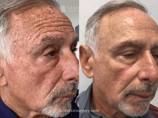 Fraxal and Q-Switched Ruby Laser for Sun Damage – RO