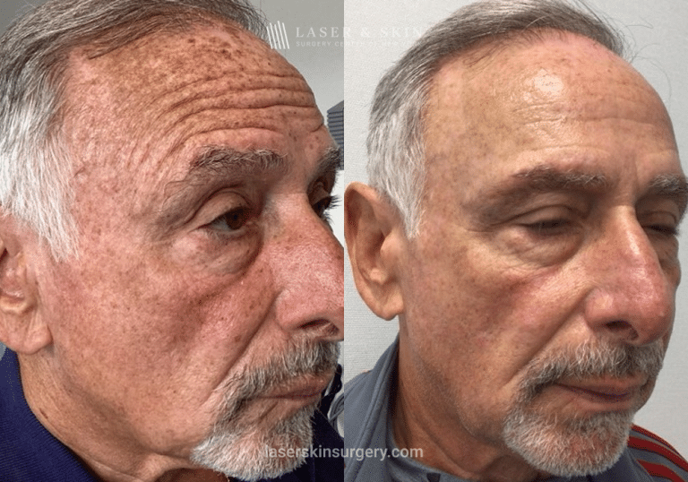 Fraxal and Q-Switched Ruby Laser for Sun Damage – RO
