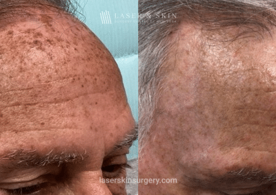 Fraxal and Q-Switched Ruby Laser for Sun Damage – RO Forehead