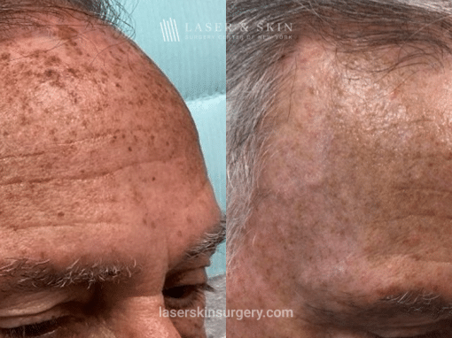 Fraxal and Q-Switched Ruby Laser for Sun Damage – RO Forehead