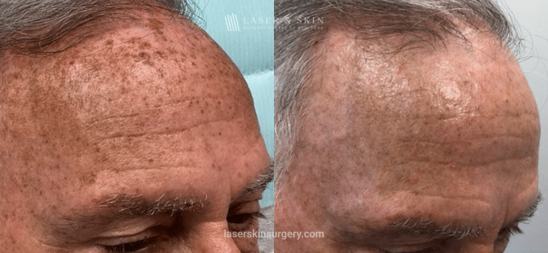 Fraxal and Q-Switched Ruby Laser for Sun Damage – RO Forehead