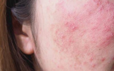 Atopic Vs. Contact Dermatitis: Understanding The Difference