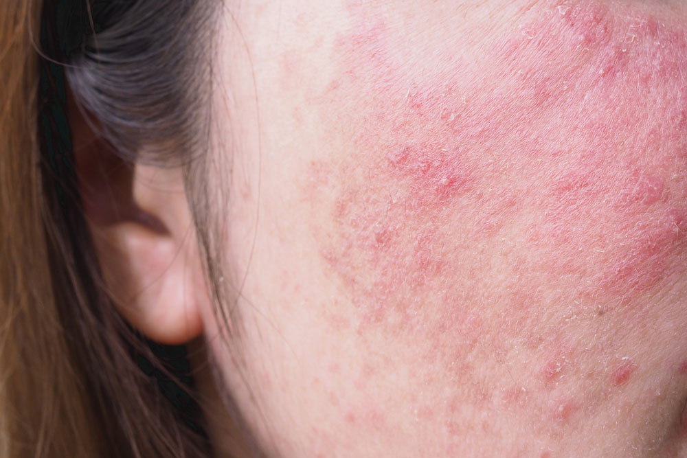 Atopic Vs. Contact Dermatitis: Understanding The Difference