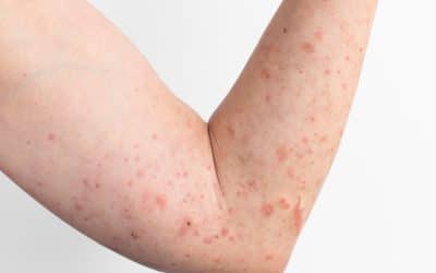 Understanding The Root Causes Of Atopic Dermatitis
