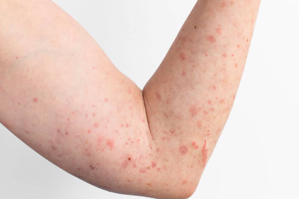 skin-allergy-reaction-test-person-s-arm_new