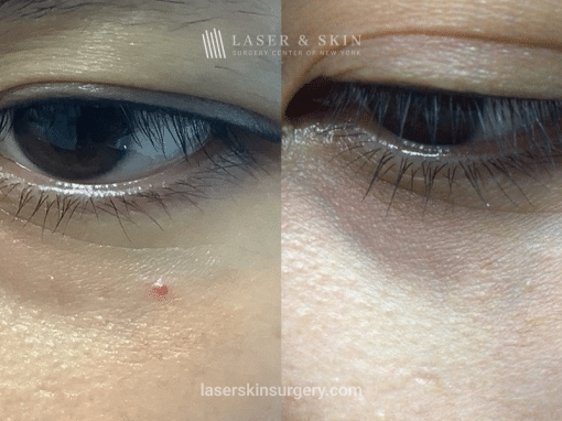Vbeam Laser Treatment for Infraorbital Angioma