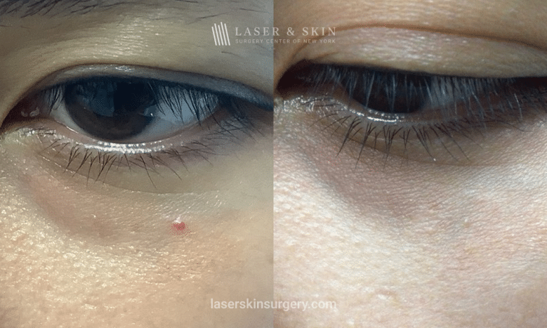 Vbeam Laser Treatment for Infraorbital Angioma