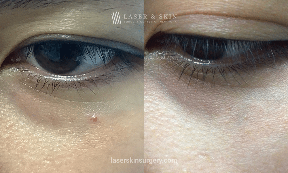 Vbeam Laser Treatment for Infraorbital Angioma