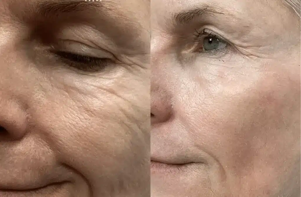 CO2 Laser Resurfacing – Lower Eyelids Left