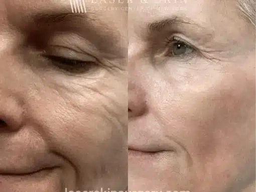 CO2 Laser Resurfacing – Lower Eyelids Left