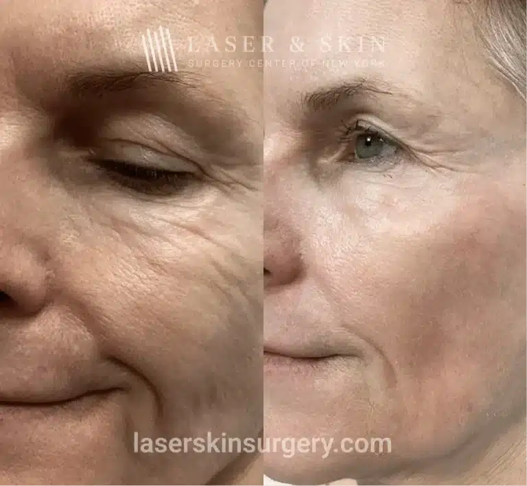 CO2 Laser Resurfacing – Lower Eyelids Left