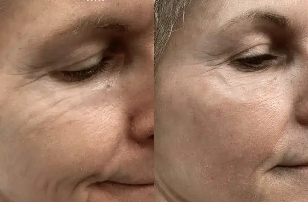 CO2 Laser Resurfacing – Lower Eyelids Right