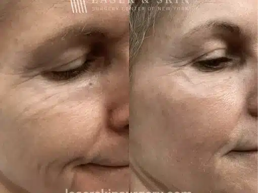 CO2 Laser Resurfacing – Lower Eyelids Right