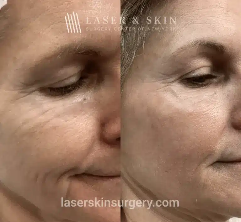 CO2 Laser Resurfacing – Lower Eyelids Right