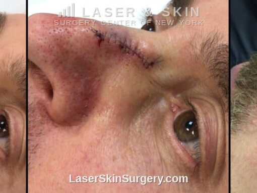 MOHS Surgery