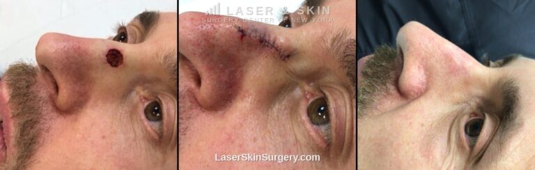 MOHS Surgery